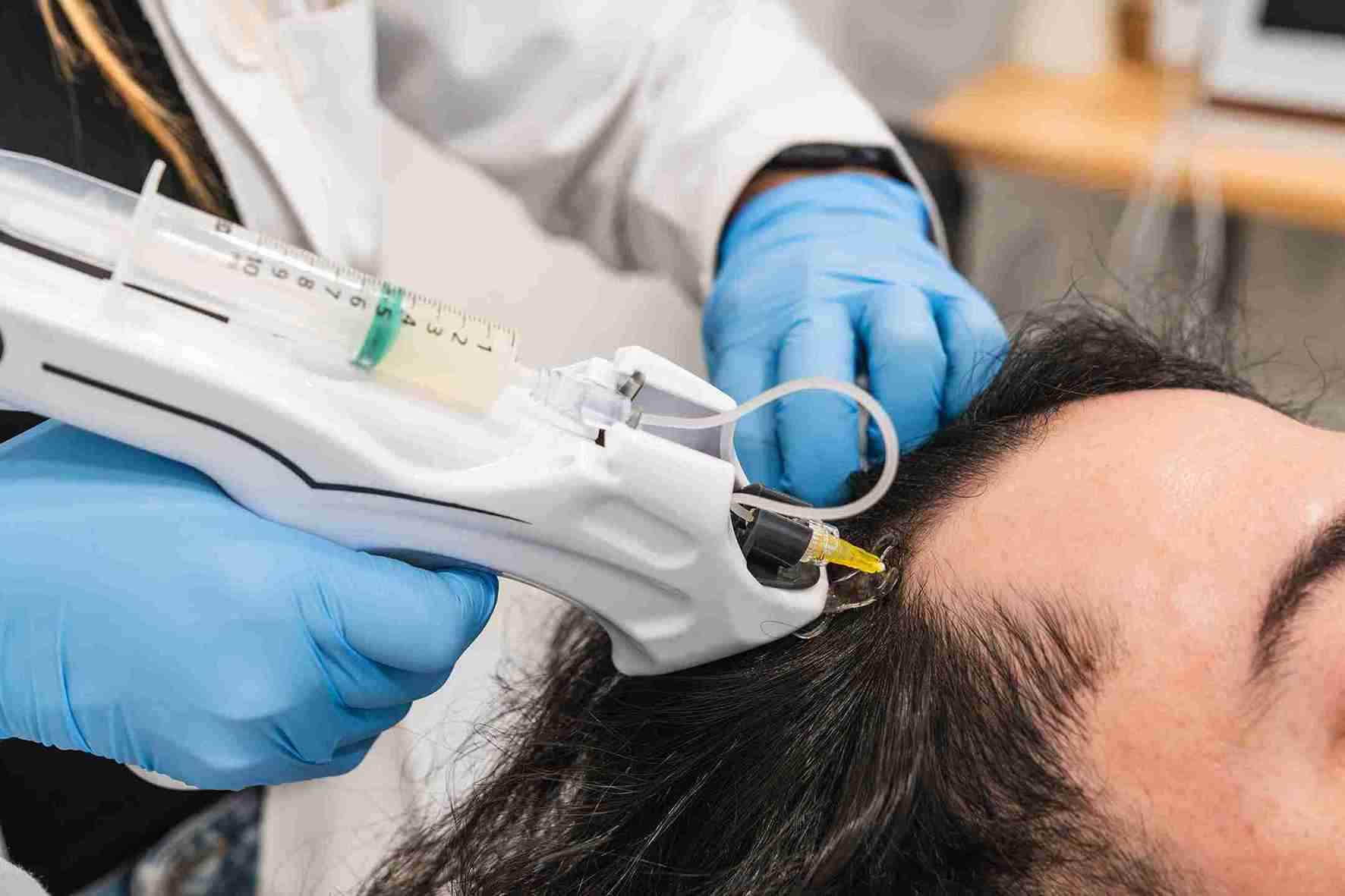Doctor applies a plasma treatment to the patient's scalp for hair regeneration
