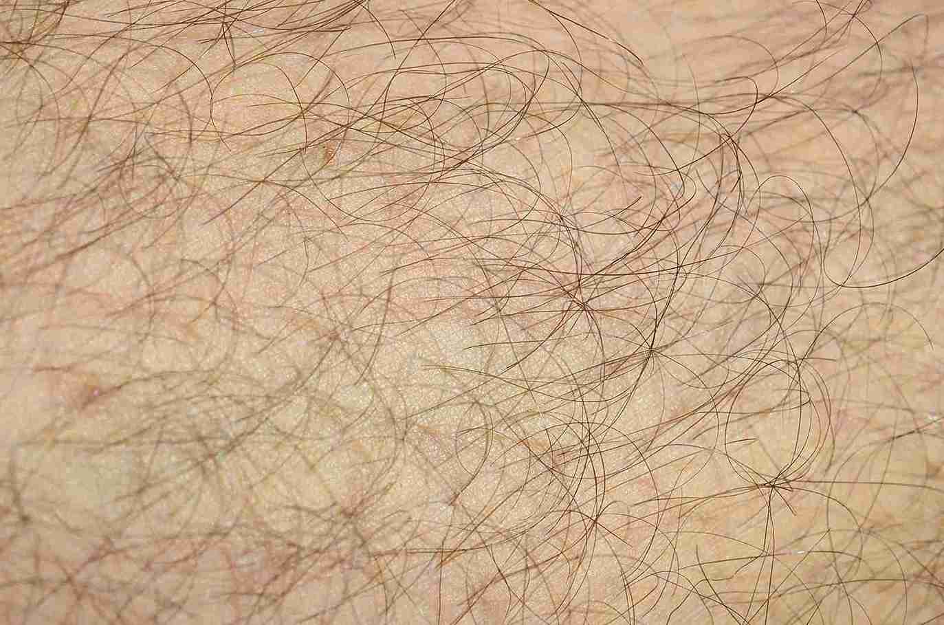 Artikelbild für Haartransplantation woher Haare?