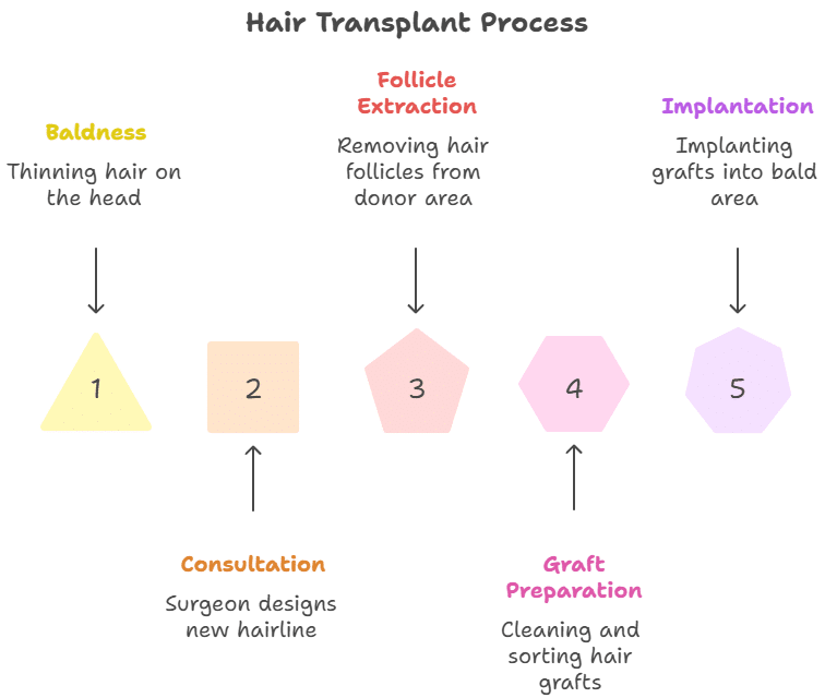 Infographic showing the hair transplant process in five steps: 1. Baldness – thinning hair on the head, 2. Consultation – surgeon designs new hairline, 3. Follicle Extraction – removing hair follicles from donor area, 4. Graft Preparation – cleaning and sorting hair grafts, 5. Implantation – implanting grafts into bald area.