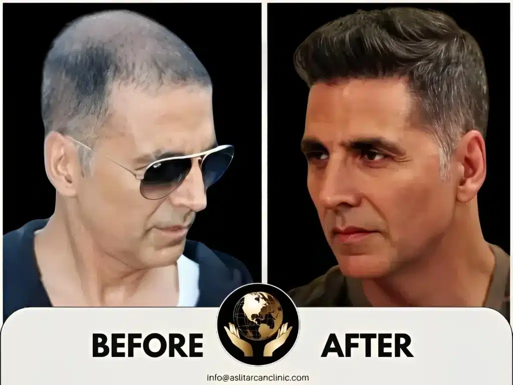 Before And After Transformation of Akshay Kumar
