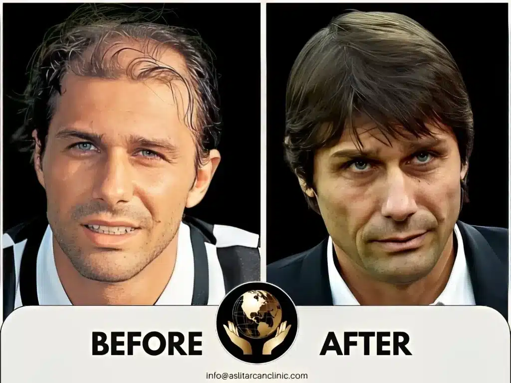 Before And After Transformation of Antonio Conte