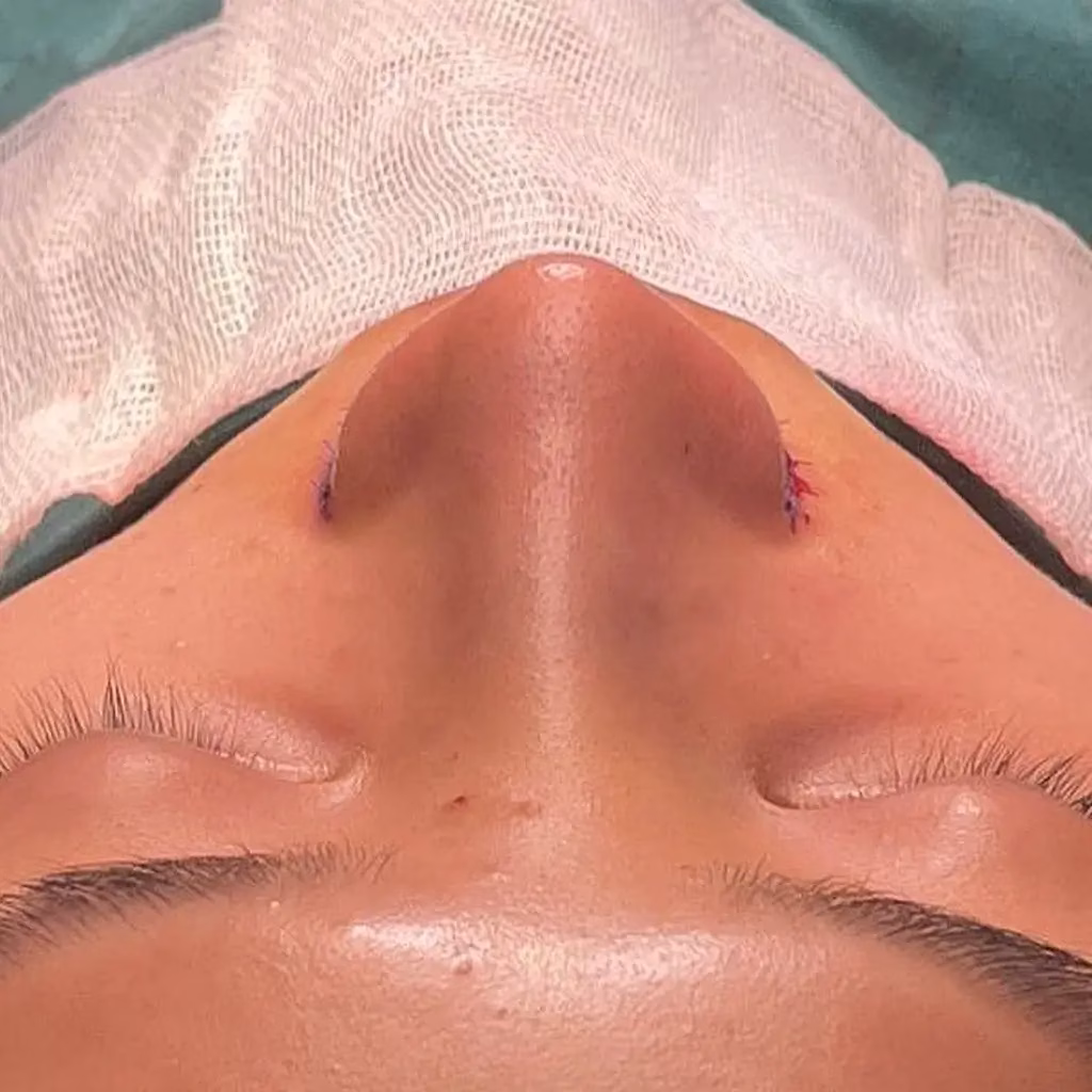 Frontal view of a freshly operated nose with small stitches and slight redness after an Asian rhinoplasty.