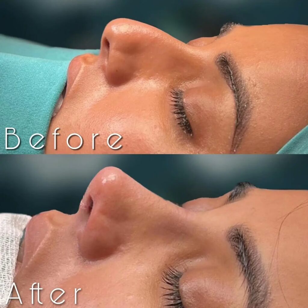 Side-profile before-and-after comparison of an Asian rhinoplasty procedure, showing a refined nasal bridge and tip with subtle, natural-looking enhancement.