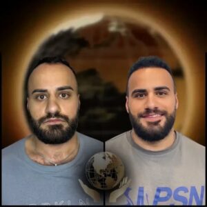 Before-and-After-hair-transplant-at-asli-tarcan-clinic