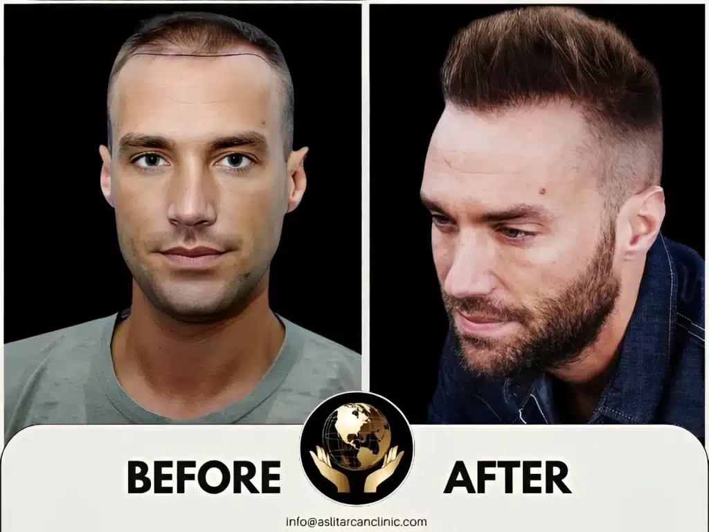 Before And After Transformation of Calum Best