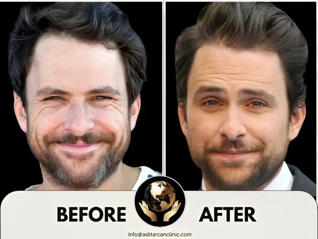 Before And After Transformation of Charlie Day