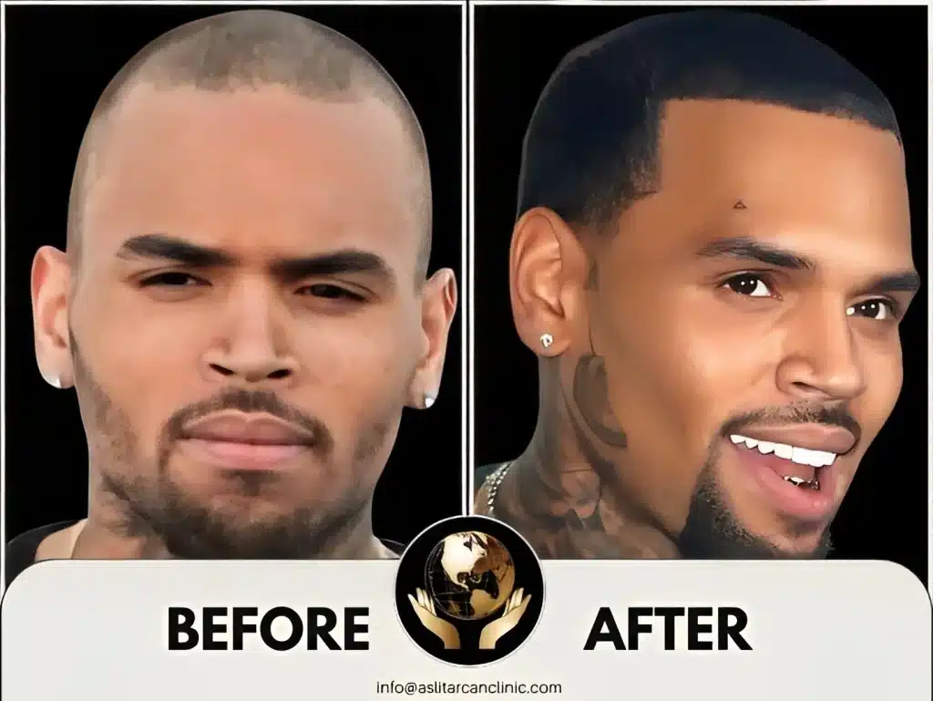 Before And After Transformation of Chris Brown
