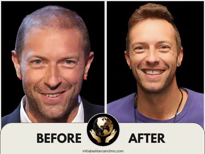 Before And After Transformation of Chris Martin