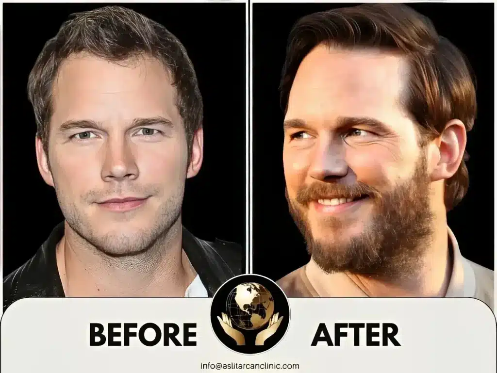 Before And After Transformation of Chris Pratt