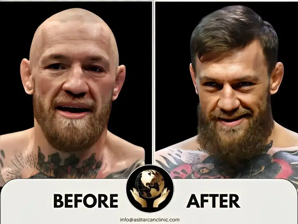 Before And After Transformation of Connor McGregor