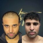 DHI-hair-transplant-turkey-before-and-after-2