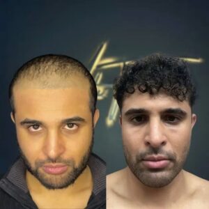 DHI-hair-transplant-turkey-before-and-after-2