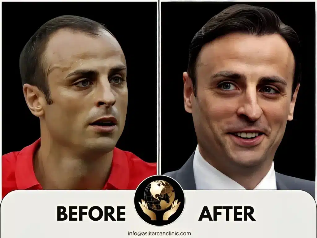 Before And After Transformation of Dimitar Berbatov