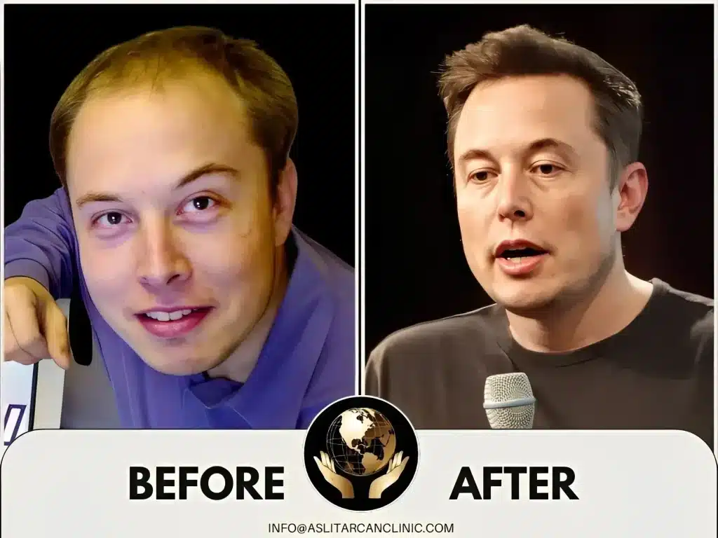 Before And After Transformation of Elon Musk