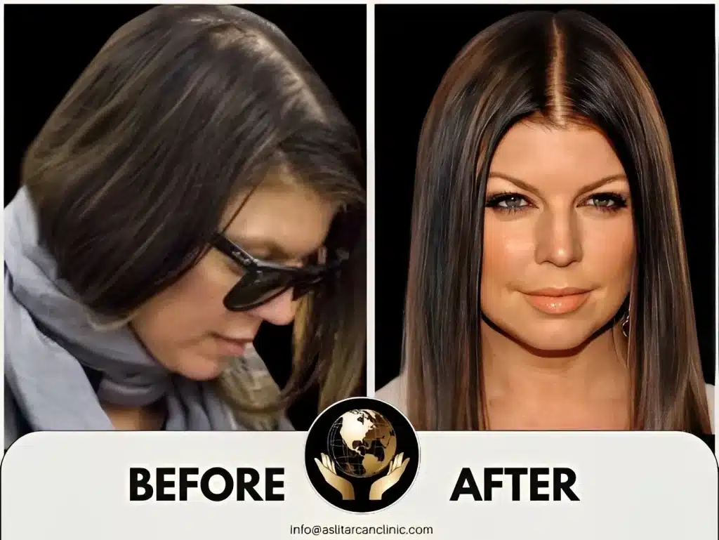 Before And After Transformation of Fergie