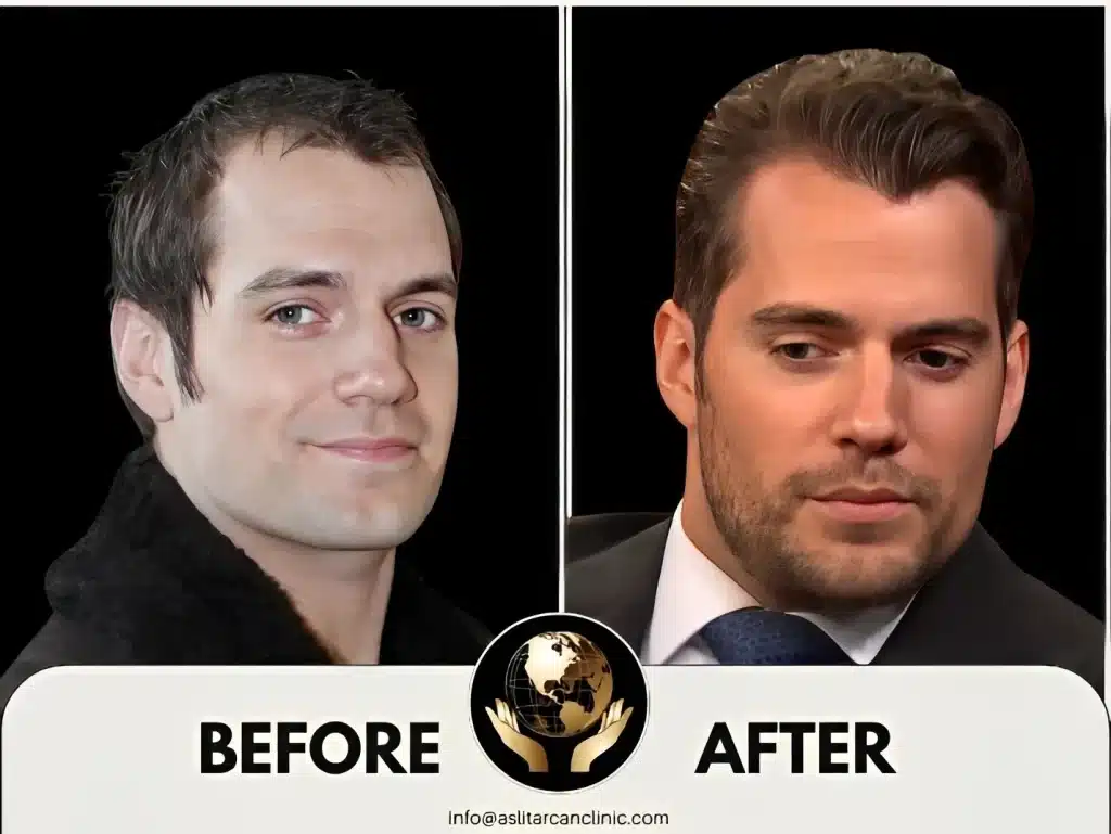 Before And After Transformation of Henry Cavill