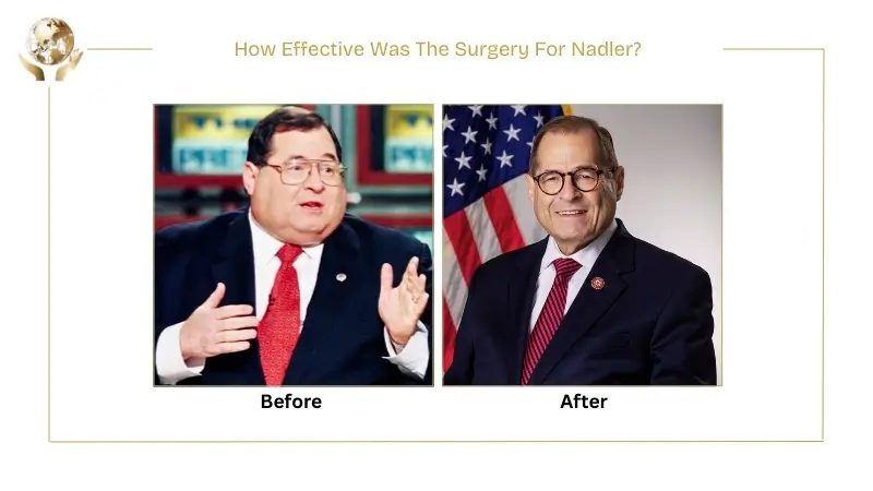 Before-and-after photos of Jerry Nadler showing visible weight loss following surgery.