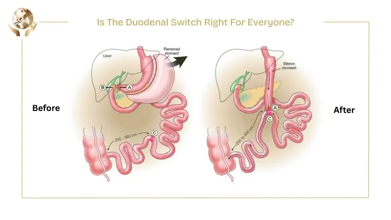 Before-and-after medical diagram of duodenal switch surgery, showing stomach reduction and rerouting of the intestines.