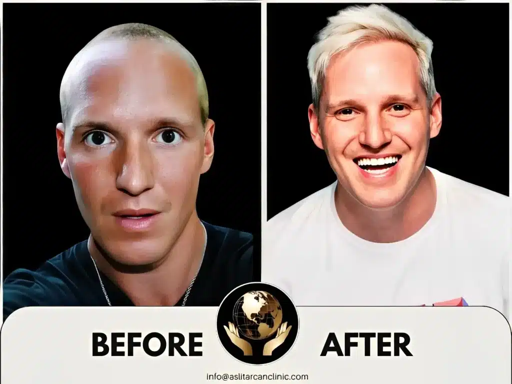 Before And After Transformation of Jamie Laing