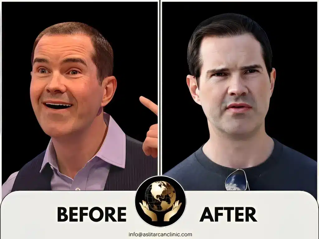 Before And After Transformation of Jimmy Carr