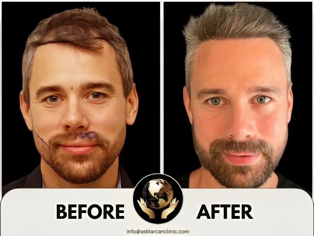 Before And After Transformation of Joey Lawrance