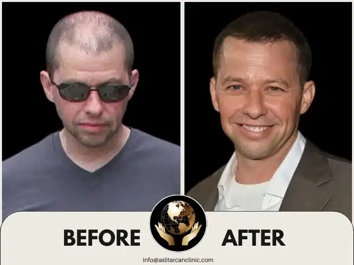 Before And After Transformation of Jon Cryer