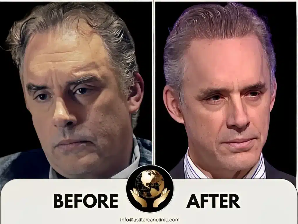 Before And After Transformation of Jordan Peterson