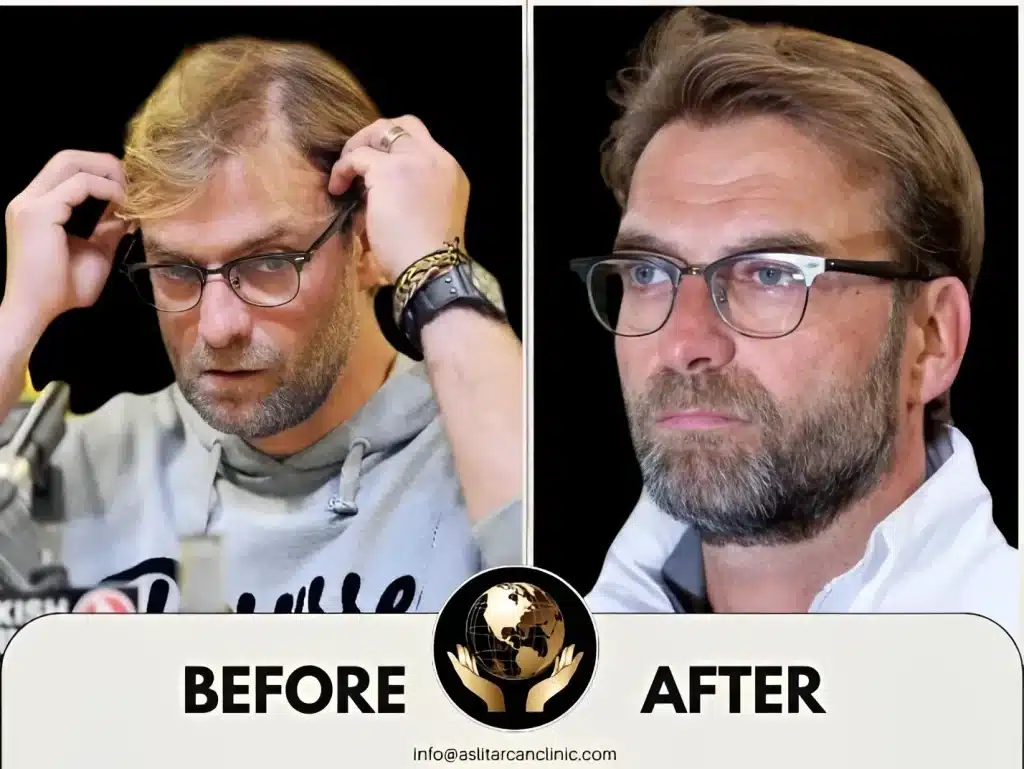 Before And After Transformation of Jürgen Klopp
