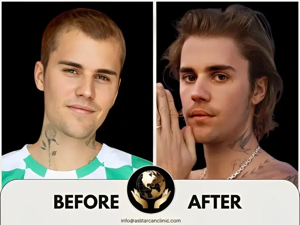 Before And After Transformation of Justin Bieber