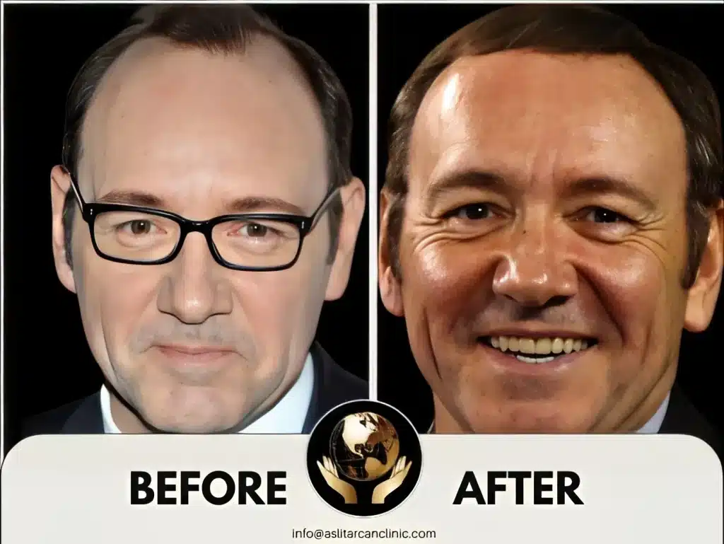 Before And After Transformation of Kevin Spacey