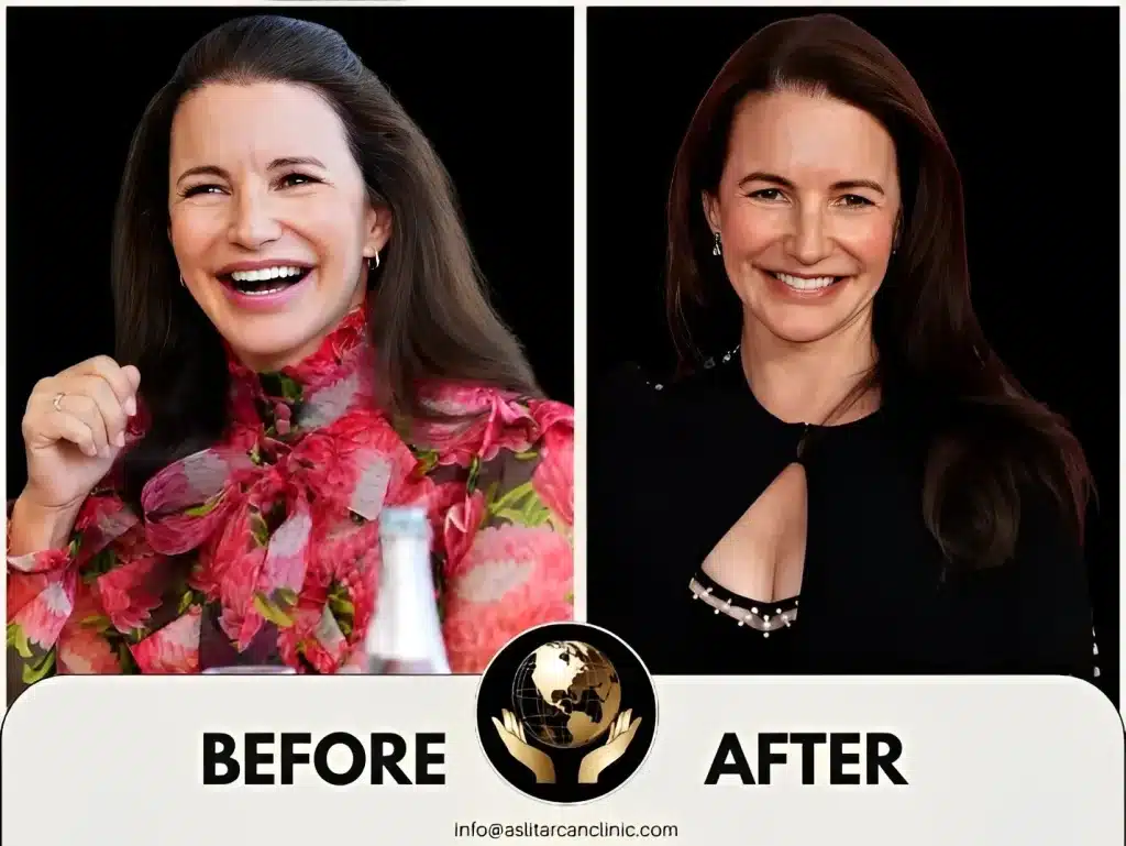 Before And After Transformation of Kristin Davis