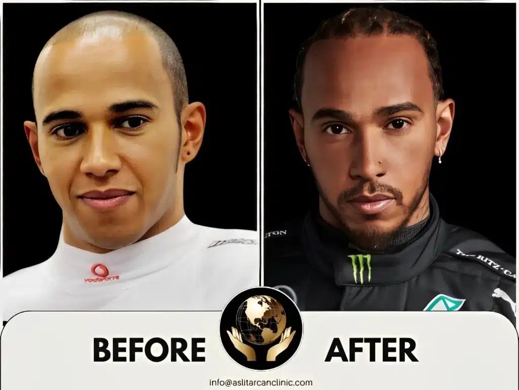 Before And After Transformation of Lewis Hamilton