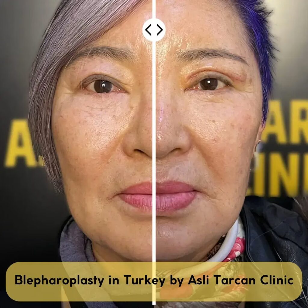 Vorher-nachher-Bild einer Frau nach einer Lidstraffung mit sichtbar gestrafften Oberlidern.