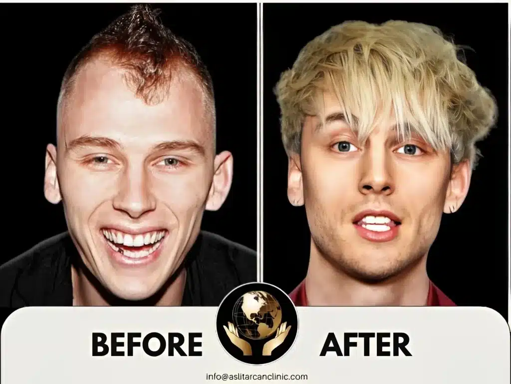 Before And After Transformation of Machine Gun Kelly