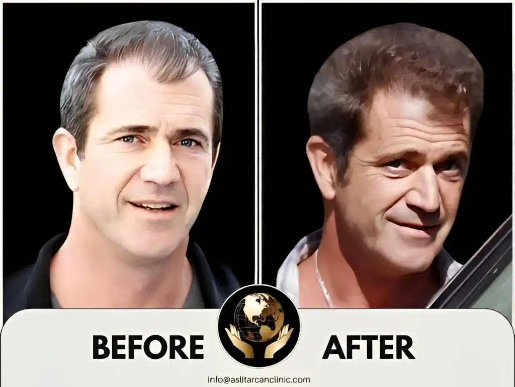 Before And After Transformation of Mel Gibson