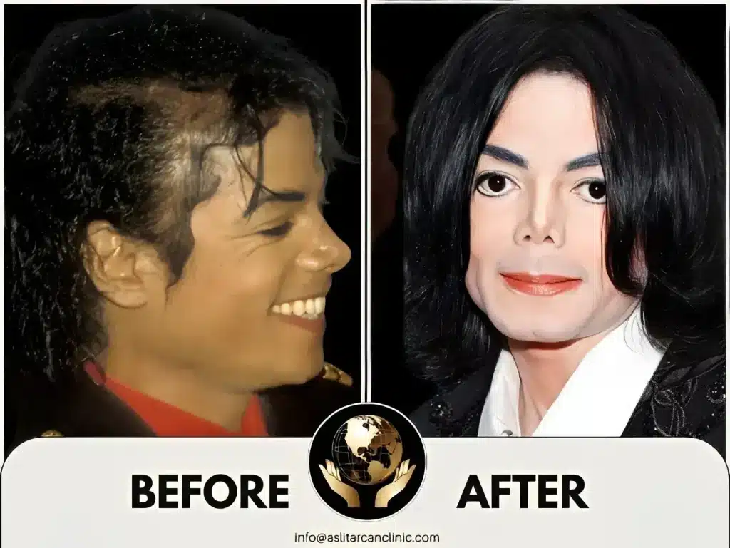Before And After Transformation of Michael Jackson