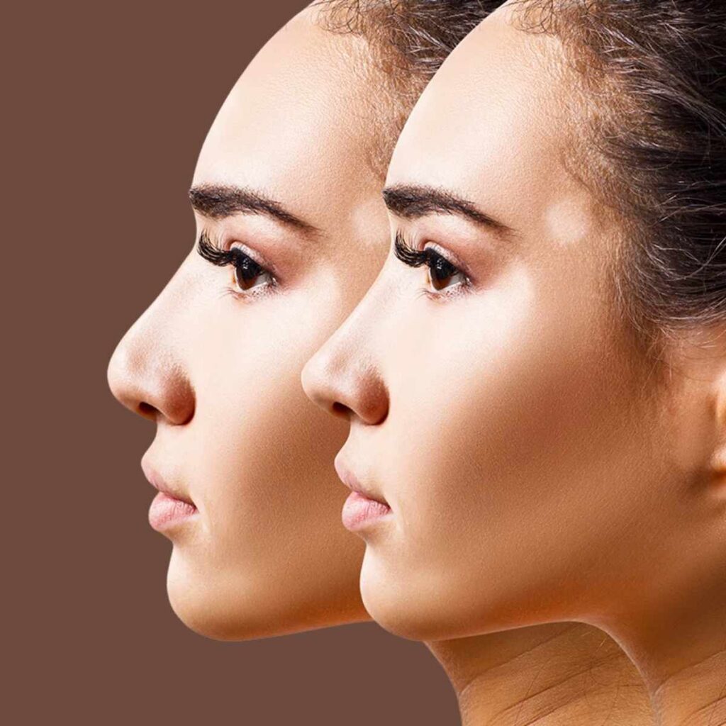 Vorher-nachher Profilbild einer Frau mit korrigierter Nase nach einer Nasen-OP Türkei.