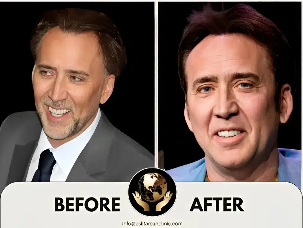 Before And After Transformation of Nicolas Cage