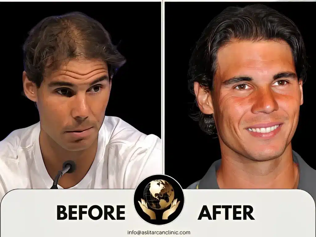 Before And After Transformation of Rafeal Nadal