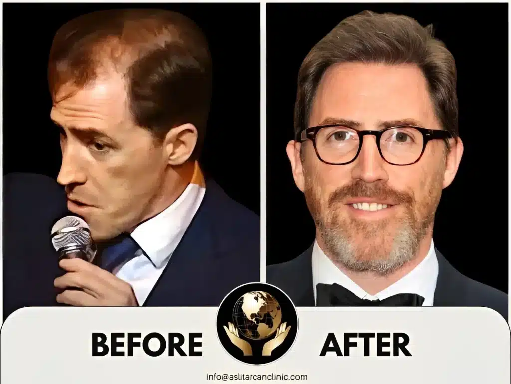 Before And After Transformation of Rob Brydon