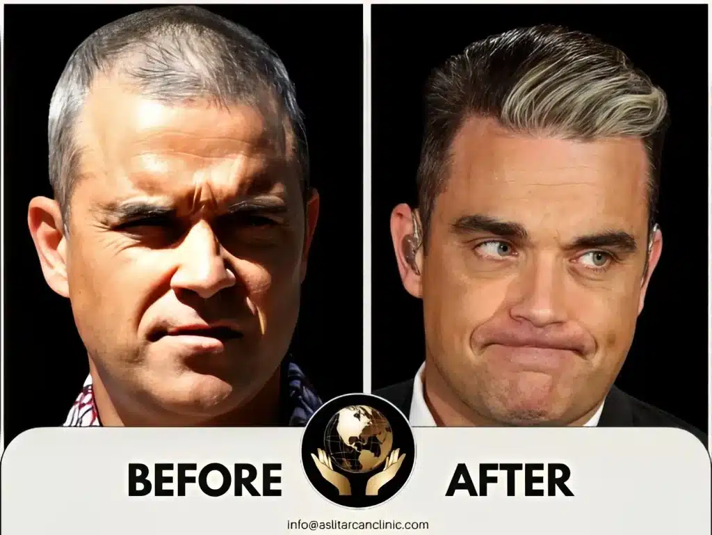 Before And After Transformation of Robbie Williams