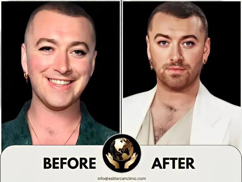 Before And After Transformation of Sam Smith