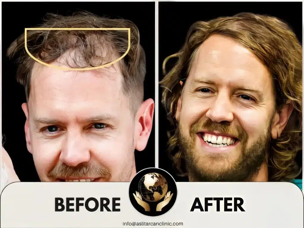 Before And After Transformation of Sebastian Vettel