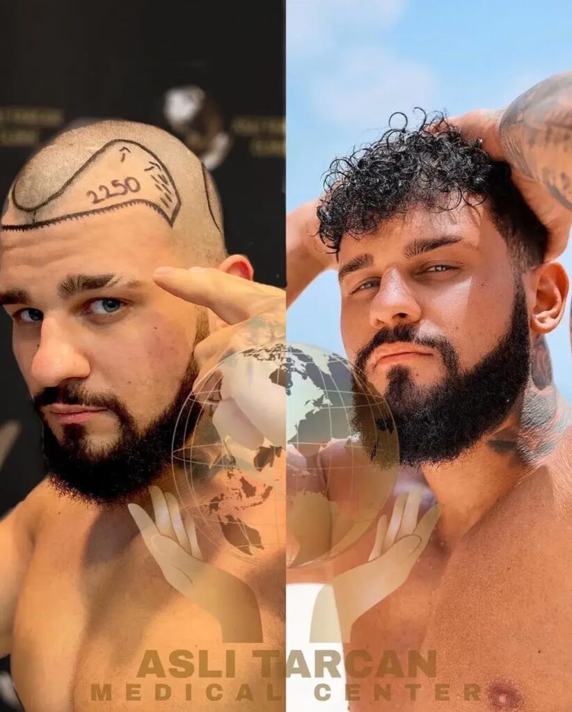 Vorher-nachher-Bild eines Mannes mit markierter Stirnverkleinerung und voller Haarlinie danach.