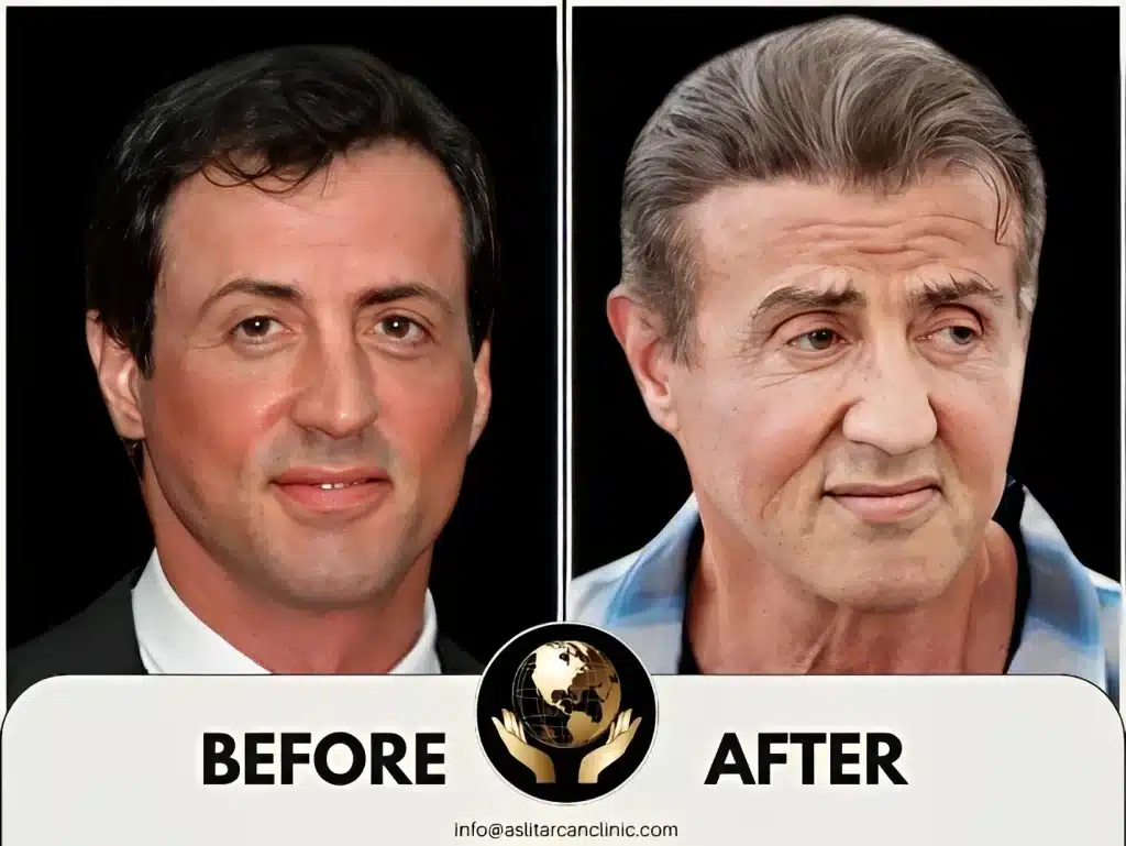 Before And After Transformation of Sylvester Stallone