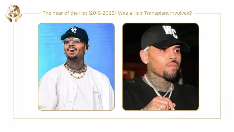 Two side-by-side images titled ‘The Year of the Hat (2016–2023): Was a Hair Transplant Involved?’ showing Chris Brown frequently wearing hats and caps. Both images depict him smiling or posing at public events with headwear covering his hairline, emphasizing a period when his hairstyle was often concealed.