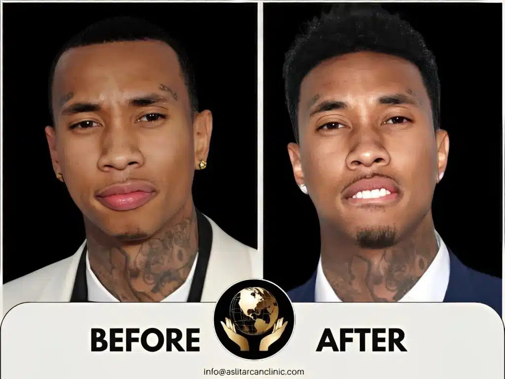 Before And After Transformation of Tyga