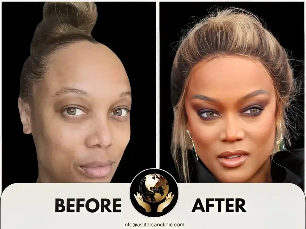Before And After Transformation of Tyra Banks