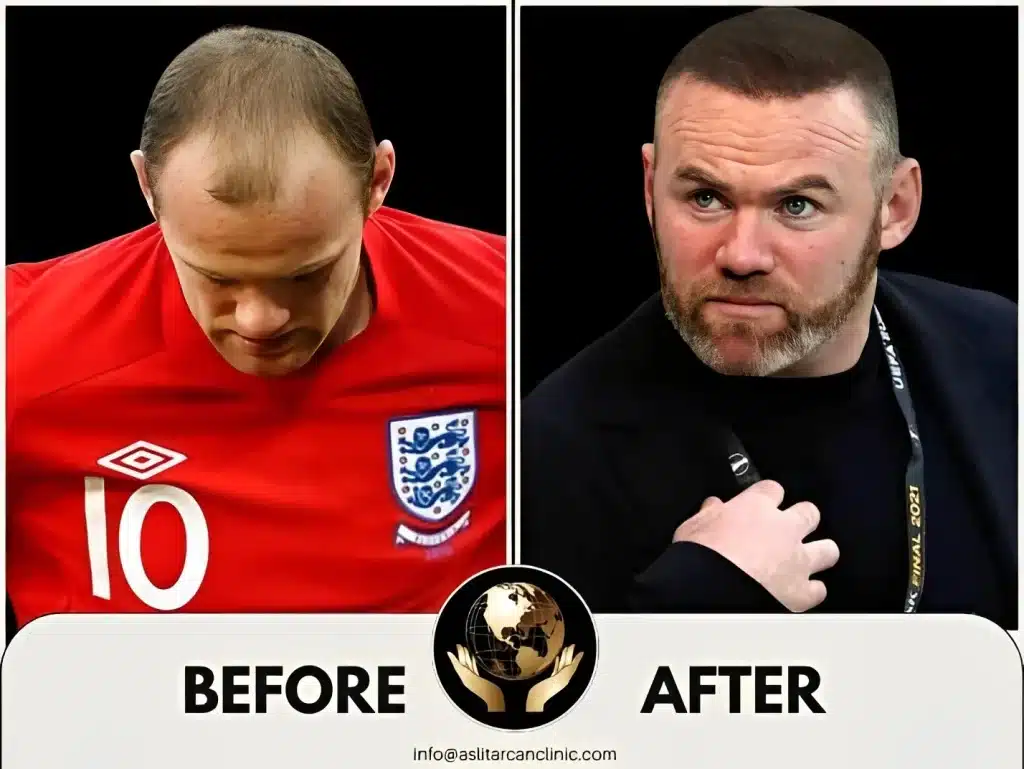 Before And After Transformation of Wayne Rooney