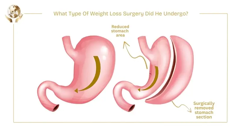 Medical diagram illustrating weight loss surgery, showing a normal stomach compared to a surgically reduced stomach with a removed section.